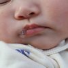 嬰兒口水疹