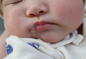 嬰兒口水疹