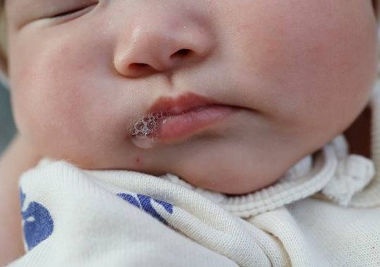 嬰兒口水疹
