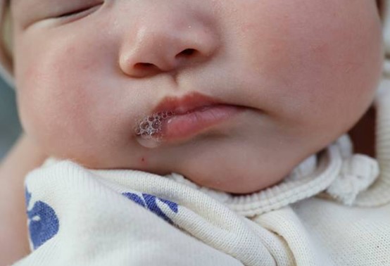 嬰兒口水疹