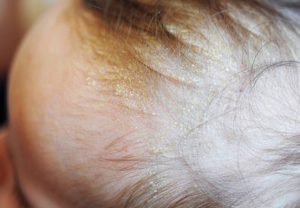 嬰兒頭皮乾燥脫皮